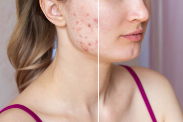 Cropped shot of a young woman's face before and after acne treatment on face. Pimples, red scars on...