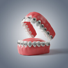 Metalic Orthodontics