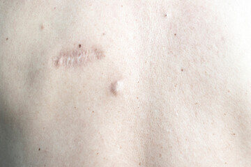 Image of a person's skin with scars