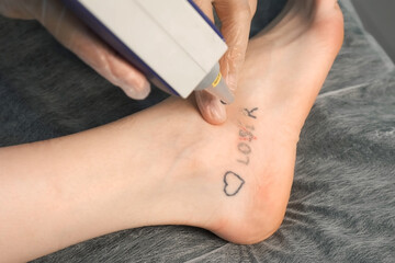 Laser removing of tattoo with words loser, lover and heart on woman's foot in red and black colours, closeup hands of doctor in gloves. Romantic tattoo symbol of youth love and disappointment in life.