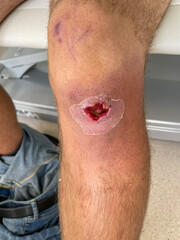 VERTICAL: Close up shot of a young man's open wound after abscess drainage.