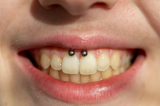 Piercing on the upper lip in a young girl. Closeup.