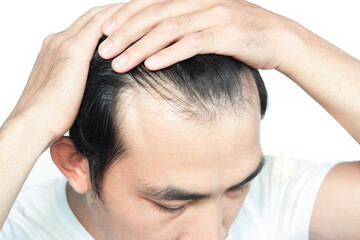 Closeup Young man serious hair loss problem with white backgroun for health care medical and shampoo product concept, selective focus