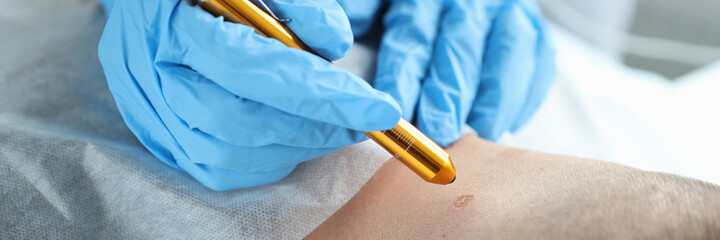 Laser removal of a mole on man neck in beauty salon