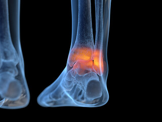 3d rendered illustration of an inflamed ankle
