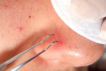 Fototapeta premium Removing blackheads on the nose