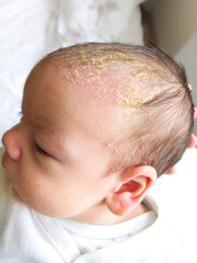Newborn baby with symptoms of cradle cap (dermatitis seborrhoicum neonatorum) on the scalp. - obrazy, fototapety, plakaty