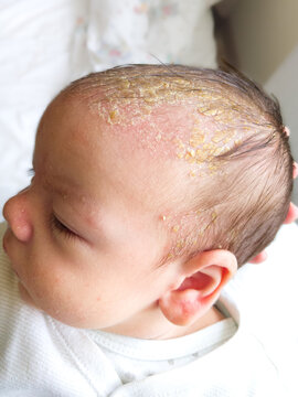 Newborn baby with symptoms of cradle cap (dermatitis seborrhoicum neonatorum) on the scalp.