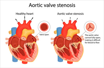 The medical illustration shows the difference between a normal aortic valve and a stenotic valve. cartoon style illustration