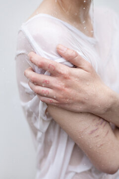 Sensual woman with pale scars arm