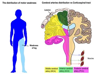 The different pattern of motor weakness according to the different location of cerebral infarction.