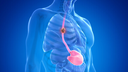 3d rendered medically accurate illustration of esophagus cancer - obrazy, fototapety, plakaty