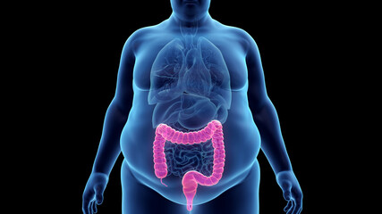 3d rendered illustration of an obese mans colon