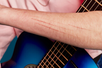 The skin condition after cat scratch and bite of veterinary surgeon hand during physical examination in a veterinary clinic.