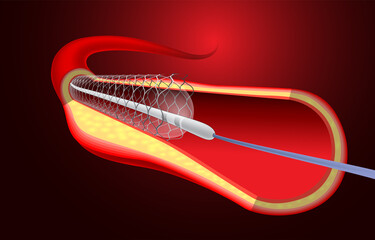 Medical and educational illustration of stent implantation to support blood flow into the blood vessels.