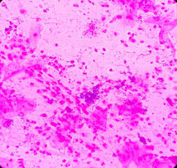 Sputum gram stain: Microscopic view show plenty pus cells and few epithelial cells with plenty gram...