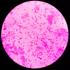 Sputum gram stain: Microscopic view show plenty pus cells and few epithelial cells with plenty gram positive diplococci and few gram negative rods bacteria.