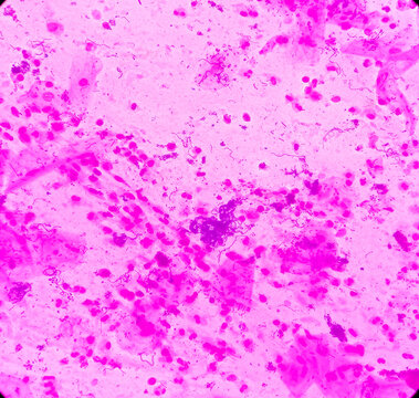 Sputum gram stain: Microscopic view show plenty pus cells and few epithelial cells with plenty gram positive diplococci and few gram negative rods bacteria.