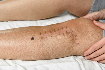Postoperative suture on woman's leg. Closeup of scar after knee fracture. Traces of interrupted...