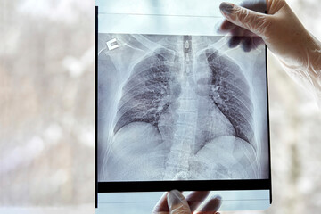 The doctor studies pathological changes in the lung tissue. Hands with chest X-ray. Selective focus.