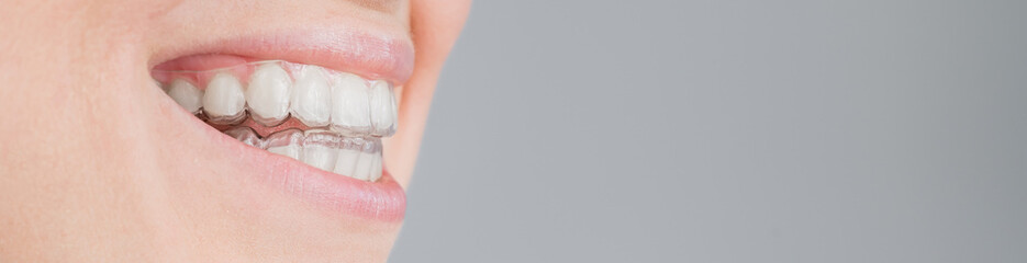 Close-up portrait of a woman putting on a transparent plastic retainer. A girl corrects a bite with...