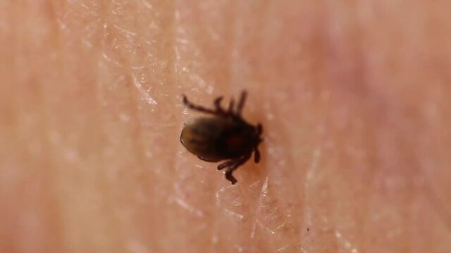 Tick Fastened to Human Skin Feeding on Blood