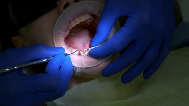 Dentist puts the thread to stop the bleeding between tooth and gum of the patient. Close-up of the oral cavity in the process of dental treatment. Dentistry, prosthetics concept. Orthodontist cure.