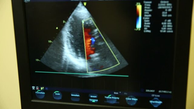 Sonography. The screen of the ultrasound machine. Results of the ultrasound on the monitor. Health care concept. 