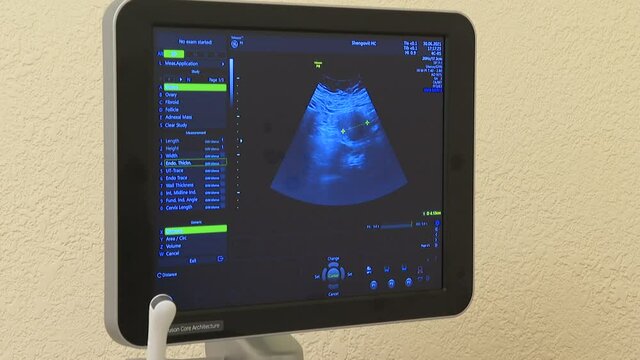 Sonography. The screen of the ultrasound machine. Results of the ultrasound on the monitor. Health care concept. 