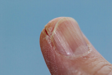 親指の先の乾燥したひび割れ