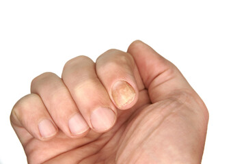 Nail fungus sample on a hand finger. An example of nail and skin health. Single palm image is on a clear white background. - obrazy, fototapety, plakaty