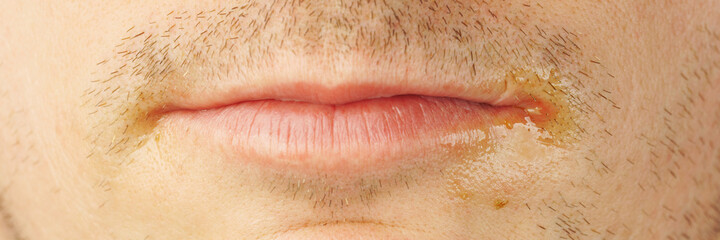 a male face with herpes sores at the corners of the lips.