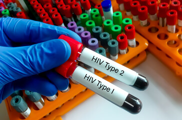Scientist hold two test tube with blood sample for HIV type 1 and HIV type 2 antibody testing, hiv screening test