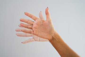 Person Hand With Dystonia