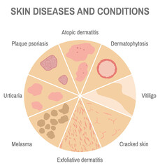 Colorful circle diagram infographic of skin diseases and conditions for medical articles, posters and banners.
