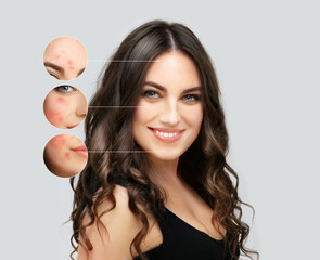 Post-Acne Marks .Treating Acne Scars