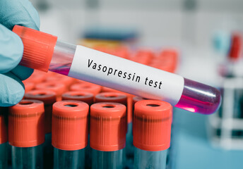 Antidiuretic hormone test tube  vasopressin  affects water retention in kidneys; controls blood...