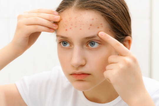 portrait of a teenage girl touches her face with pimples, acne on the skin