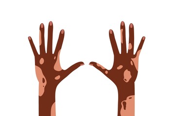 African American hands with vitiligo disorder skin. Two hands with white spots on skin. Autoimmune disease. World Vitiligo Day Colored flat cartoon vector illustration isolated on white background.