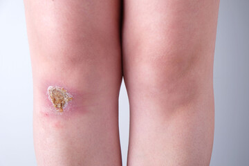 Close-up of an infected wound on  knee of  womans leg