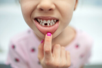 A child girl shows her mouth without one missing tooth in close-up. Lost first milk tooth. A happy...