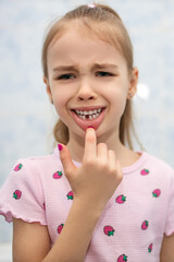 A child girl shows her mouth without one missing milk tooth and suffers pain. The first milk tooth fell out. A suffering child without a front tooth. Milk teeth concept. Preschool dental care