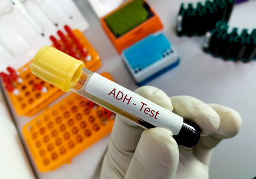 Scientist hold blood sample for ADH (Antidiuretic Hormone) test. Vasopressin. Diagnosis of water balance in body. diabetes insipidus