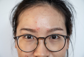 Close up of Asian woman having acne occur on her forehead. Conceptual shot of Acne and Problem Skin...