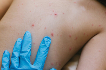 Kid's skin is covered with ulcers from chickenpox.