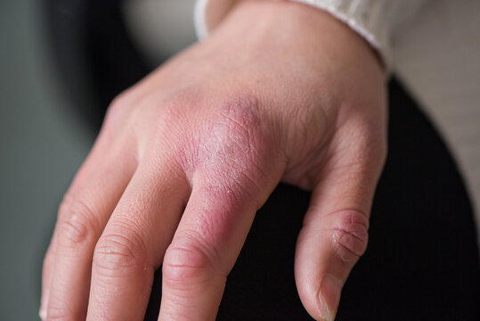close up of female hand with chilblain on white background
