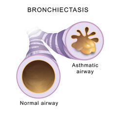 Bronchiectasis. Normal airway and asthmatic airway