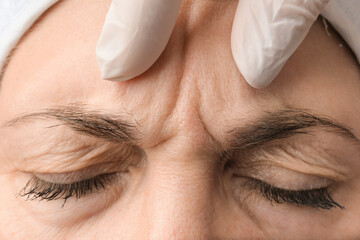 Female forehead with wrinkles