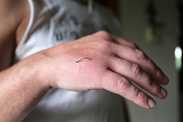 Fish Hook Embedded into skin of Man's Hand