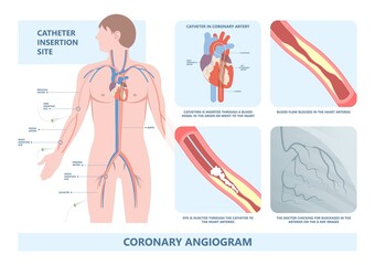 Angiography medical operation Angiogram Biopsy Angioplasty Stent Congenital Heart Defect Ablation CAG arteries plaque X-ray flow diagnose diagnosis blocked CABG valve atrial attack afib infarction - obrazy, fototapety, plakaty